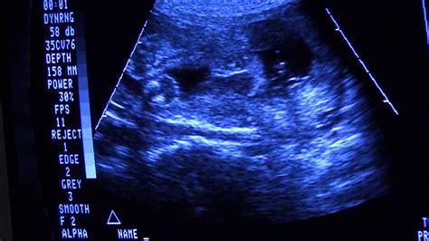 pregnancy ultrasound at 24 weeks pregnant usg gender youtube