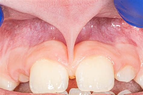 Frenectomy — Michigan Implants And Periodontics