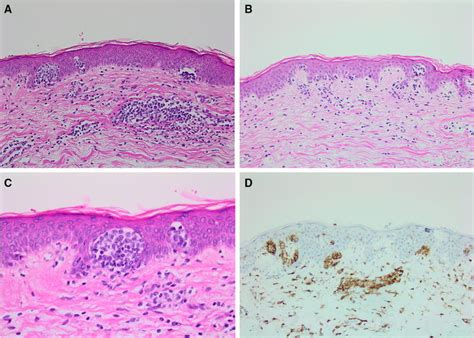 Histology Showing Pautrier Microabscesses Hande 20× B Epidermotropism