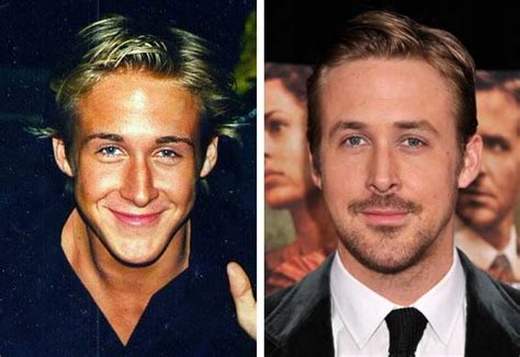 ryan gosling before and after plastic surgery vanity