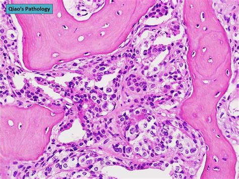 Qiaos Pathology Metastatic Prostate Cancer To Pelvic Bone A Photo