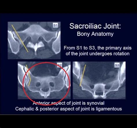 The Sacroiliac Joint Anatomy Function And Interventions