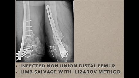 Distal Femur Infected Non Union Limb Salvage With Ilizarov Method Youtube
