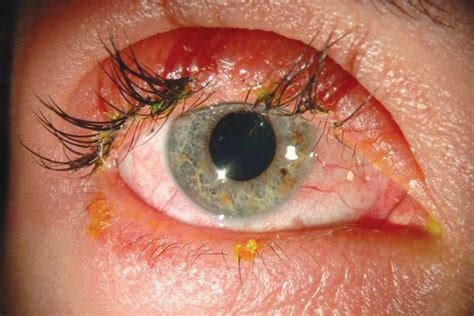 Eyelash Extensions Causing Serious Injuries Such As Chemical Burns And Infections Abc News