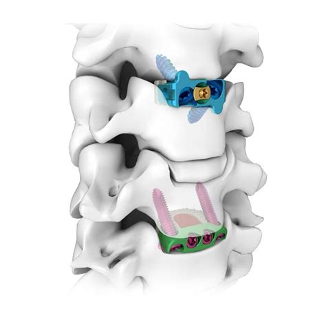 Zero Profile Anterior Cervical Intervertebral Locking Plate And Cage