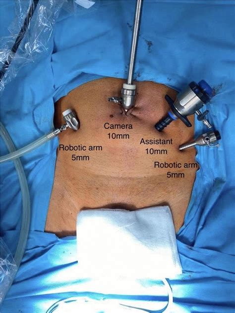 Placement Of Trocars Robotic Arms And Assistant For Radical Download Scientific Diagram