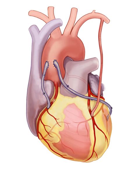 Bypass Surgery Prolonged Heart Health Avens Blog Avens Blog