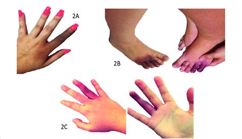Acrocyanosis Lesions On The Index Finger Of The Left Hand A Dorsal
