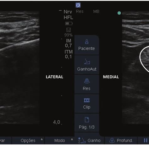 Us Guided Sciatic Nerve Block And Catheter Installation Popliteal