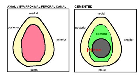 Stem Cemented — Hip And Knee Book