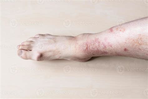 Male Shin With Itchy Red Rash On Skin 11186052 Stock Photo At Vecteezy