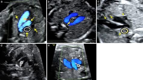 Identification And Management Of Fetal Isolated Right‐sided Aortic Arch In An Unselected