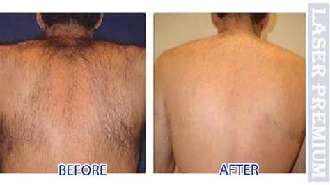 Hair Removal at Laser Premium Clinic Phuket กำจดขนถาวรแบบไมเจบ