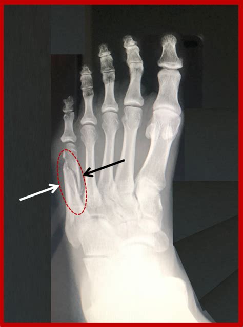 5th Metatarsal Shaft Dancer S Fracture FootEducation