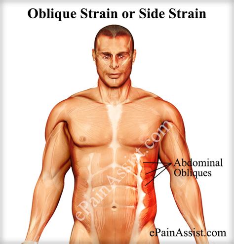 oblique strain or side strain causes symptoms treatment recovery period