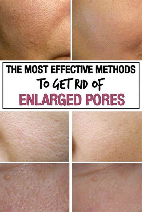The Most Effective Methods To Get Rid Of Enlarged Pores Iwomenhacks