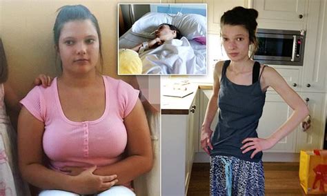 Anorexic Amber Girling Says Diet Pills Nearly Killed Her As Weight Fell