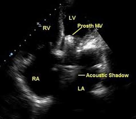 Prosthetic Mitral Valve Echocardiogram All About Cardiovascular