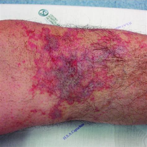 Livedo Reticularis On The Left Knee With A Violaceous Center Download