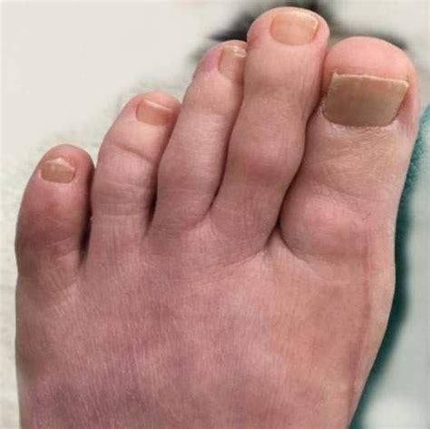 West Vancouver Foot Clinic Hammertoe And Bunion Surgical Procedures
