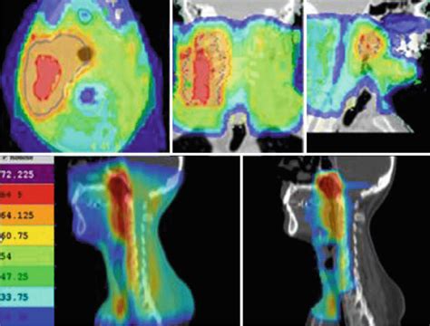 5 Radiotherapy Treatment Planning In A Patient Affected By