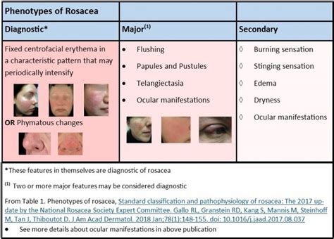 “clinical Checklist” Updated To Better Diagnose Treat Rosacea Patients