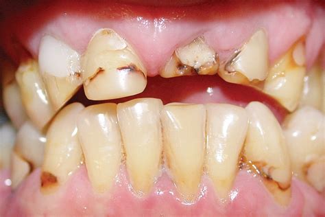 Ada Nsw Conservative Management Of The Severely Worn Dentition