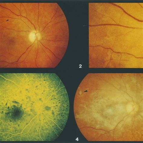 Right Fundus Before Focal Laser Photocoagulation Findings Include
