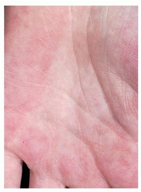 Palmar Erythema الحمامى الراحية