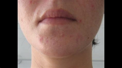 Help Tiny Bumps On Jawline And Cheek Tretinoin Images
