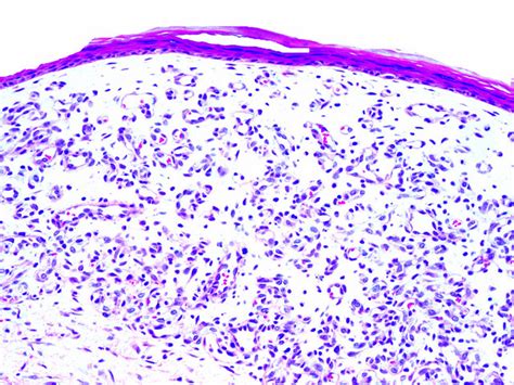 Pathology Outlines Capillary Hemangioma