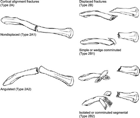 Robinsons Classification System For Midshaft Clavicular Fractures