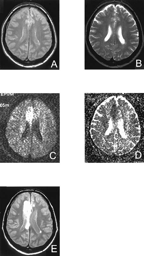 Diffusion Weighted Magnetic Resonance Imaging In Acute Stroke Stroke