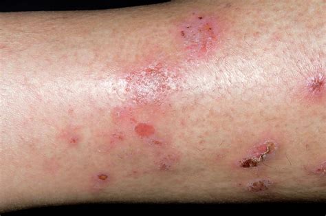 Spongiotic Dermatitis On The Leg Photograph By Dr P Marazzi Science