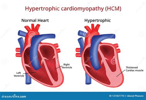 Cardiomyopathie Hypertrophique Maladie Cardiaque Image De Vecteur