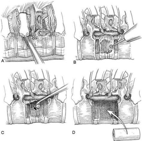 Thoracoscopic Approaches For The Treatment Of Anterior Thoracic Spinal