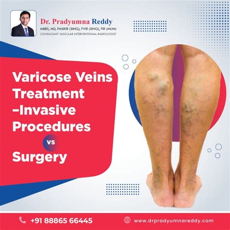 Varicose Veins Treatment Invasive Procedure Vs Surgery
