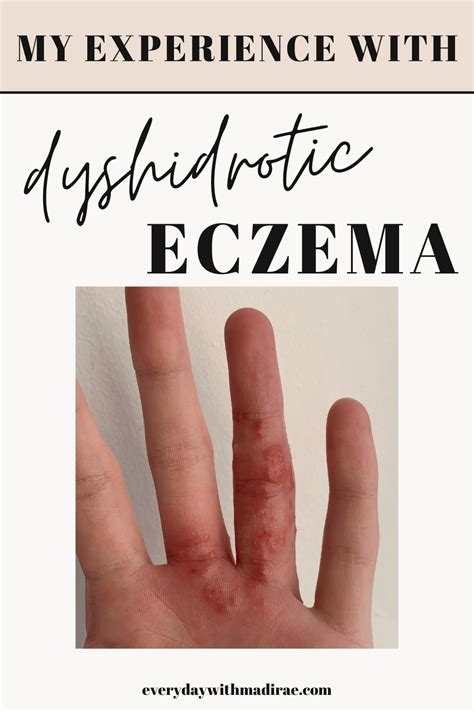 My Experience With Dyshidrotic Eczema Pompholyx