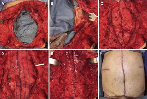 Reliable Complex Abdominal Wall Hernia Repairs With A Narrow Well