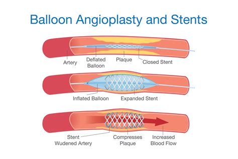 How Much Does An Angioplasty Cost In Singapore And What