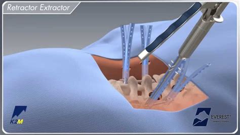 EVEREST Minimally Invasive Surgical Technique Animation YouTube