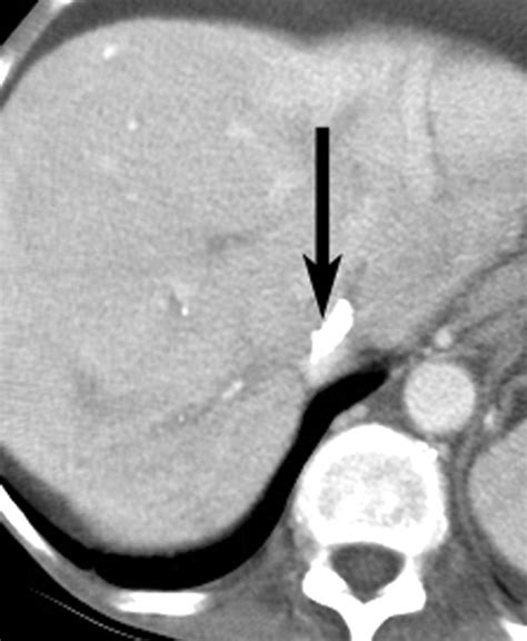 Budd Chiari Syndrome Spectrum Of Imaging Findings Ajr