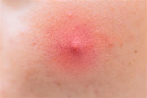 Top 10 How To Treat Pimples In The Armpit In 2022