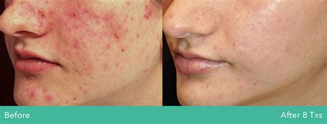Rf Microneedling Before And After Photos Secret Rf By Cutera