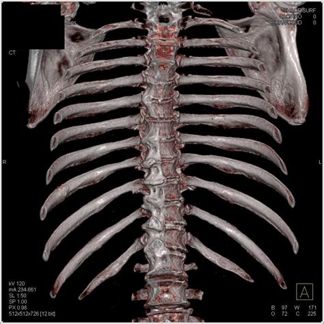 3d Of The Ribs And Spine Chest Case Studies Ctisus Ct Scanning