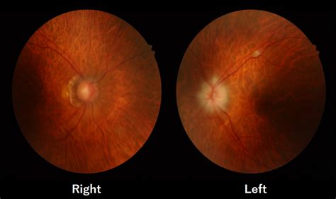 A Typical Case Of Giant Cell Arteritis With Vision Loss Due To Delayed