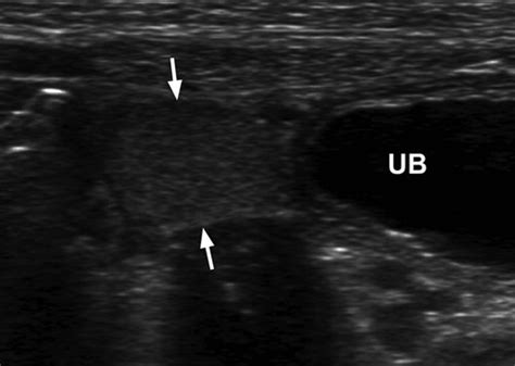 Imaging Of Ambiguous Genitalia Classification And Diagnostic Approach