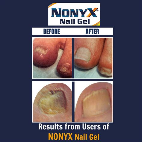 Buy Nonyx Fungal Nail Clarifying Gel Clears Out Keratin Debris Where Nail Fungus Thrives 4 Oz