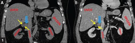 Adrenal Mass With Macroscopic Fat Found During Routine Imaging