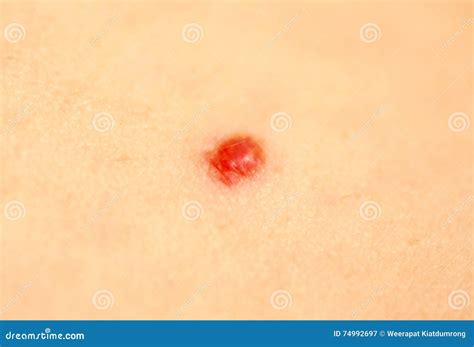 Red Spots On Skin How To Spot Skin Cancer What It Looks Like And